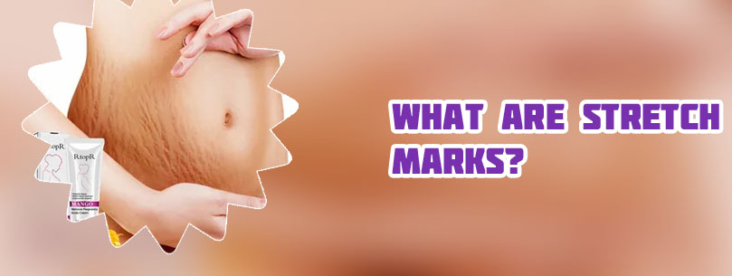 Stretch mark cream